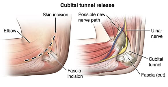 Tunel cubital