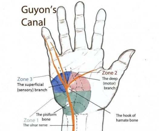 Guyon