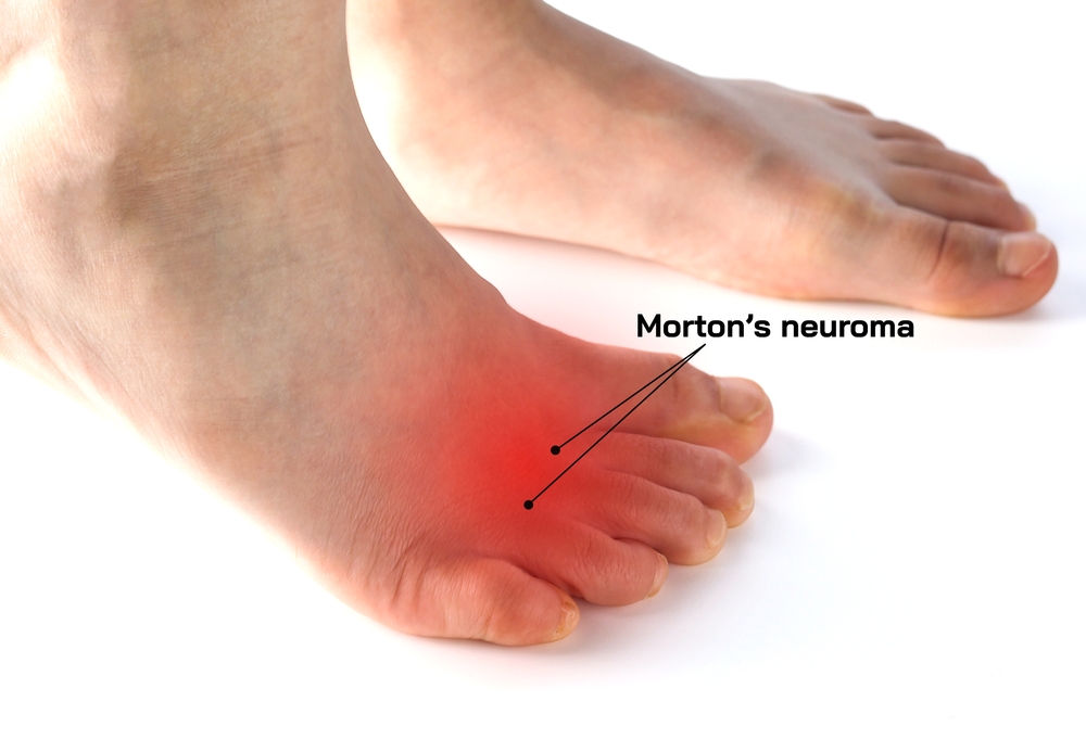Neurom Morton
