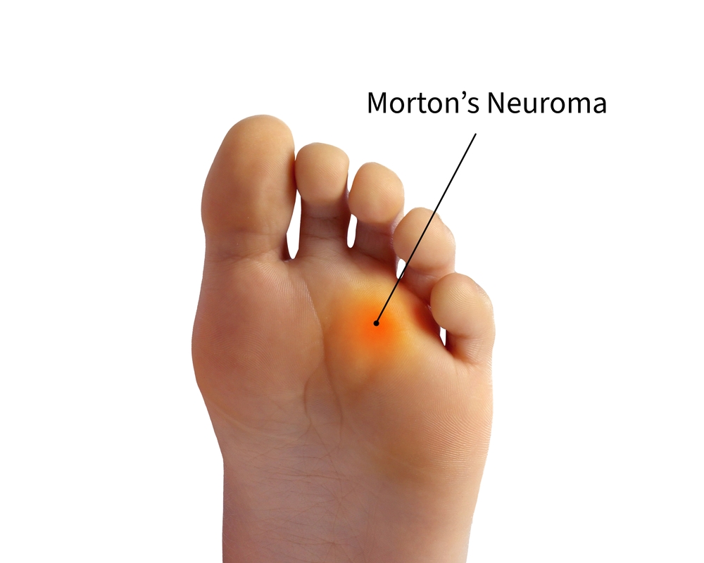 Neurom Morton