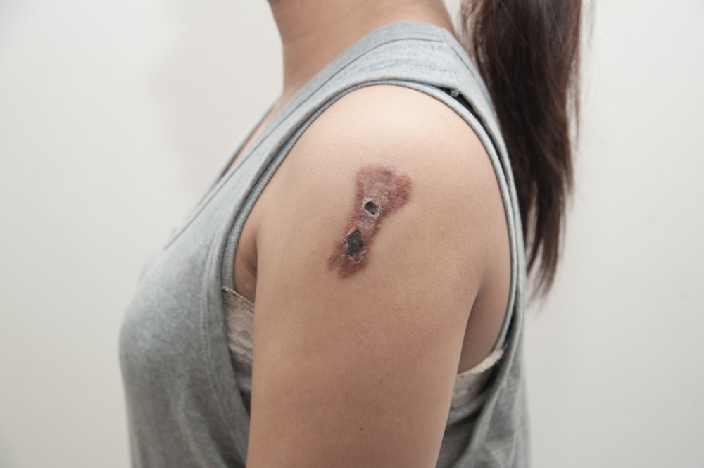 tumora epiderma