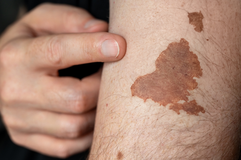 tumora epiderma