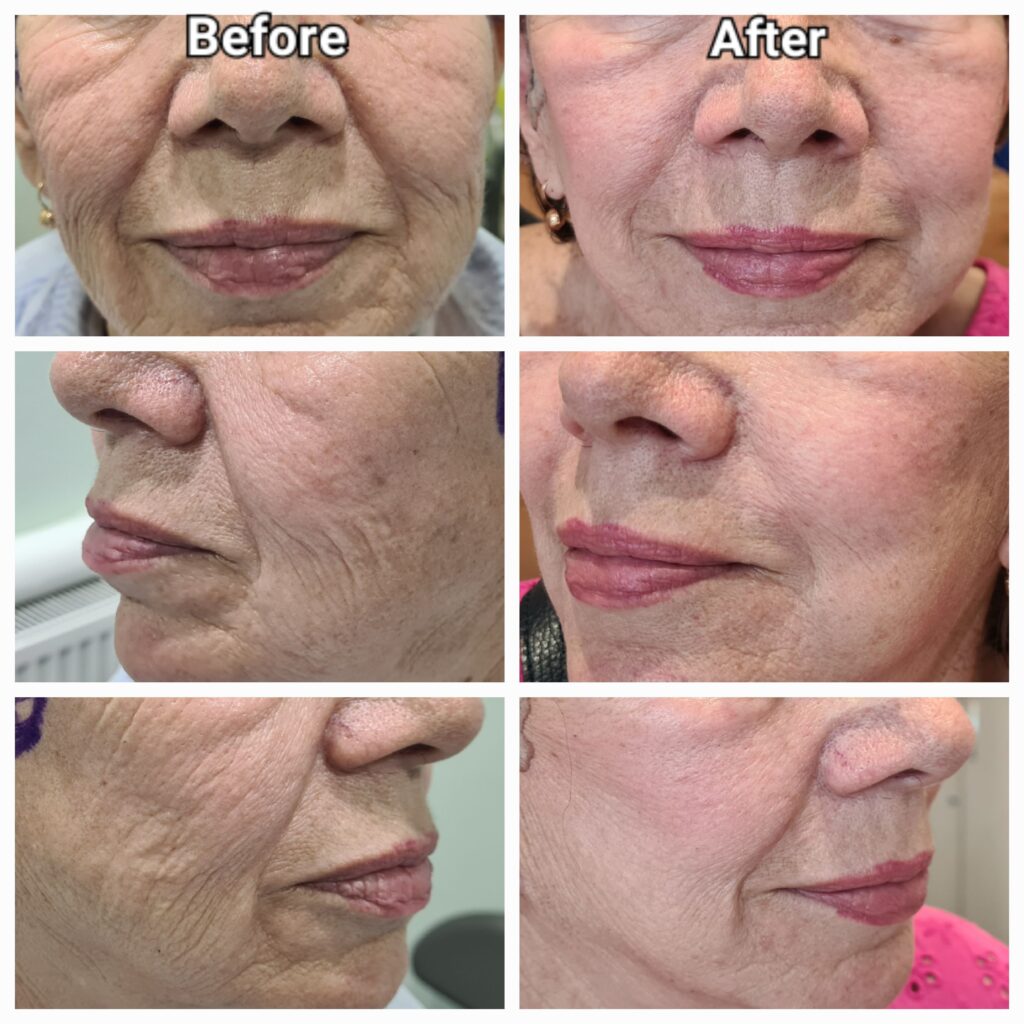 Minilifting facial