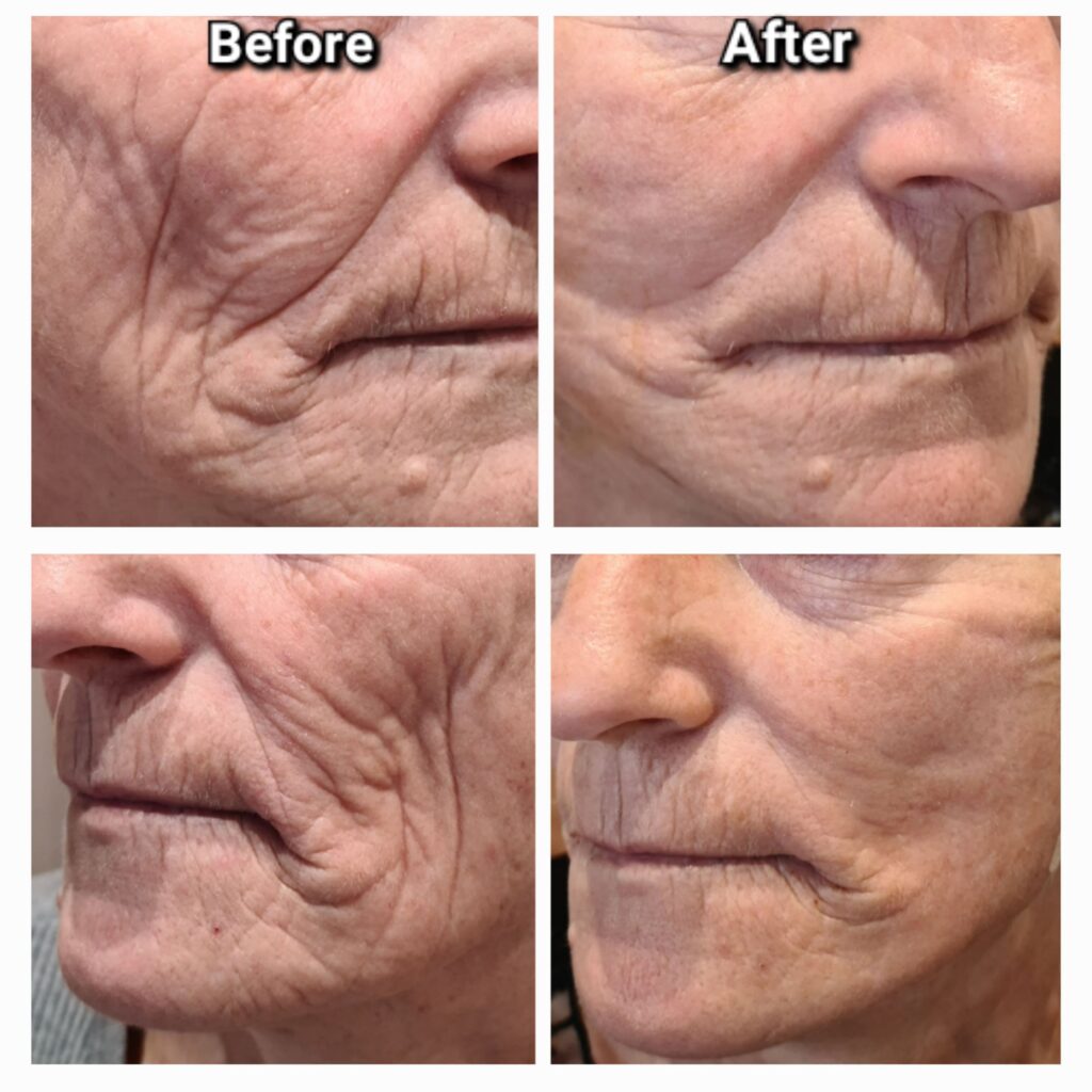 Minilifting facial