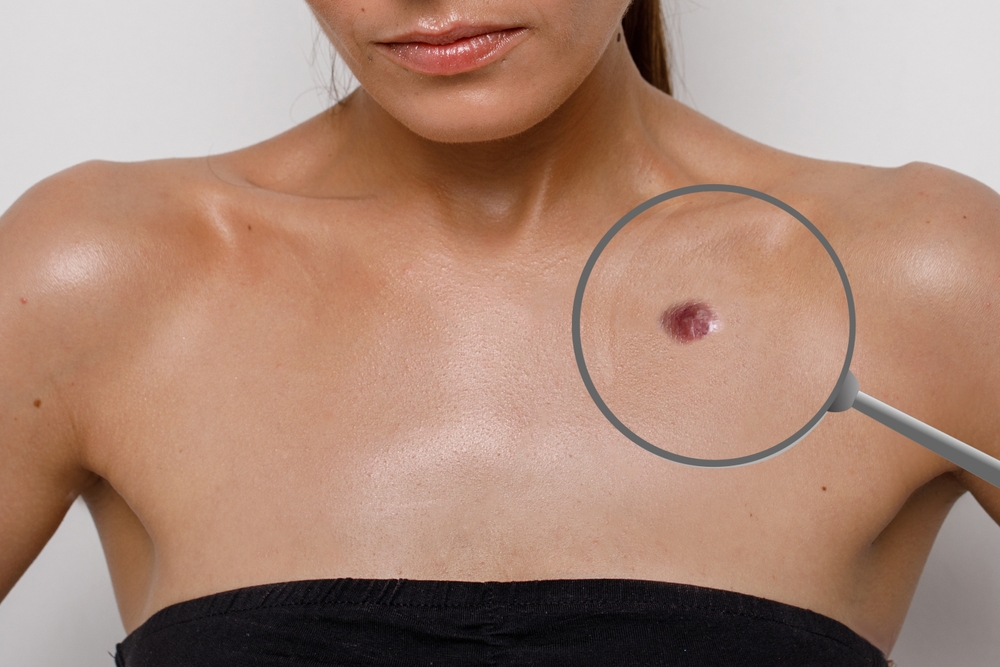 Melanom epiderma
