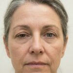 Comparatie intre o pleoapa superioara cazuta din cauza dermatocalazis si o pleoapa cu aspect normal si deschis