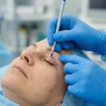 Chirurg plastician marcand zona pleoapei superioare inainte de blefaroplastie